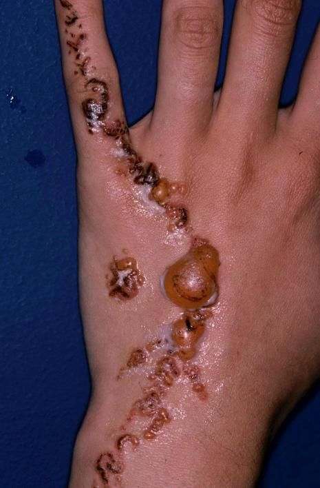 Le psoriasis sur la partie intérieure des mains