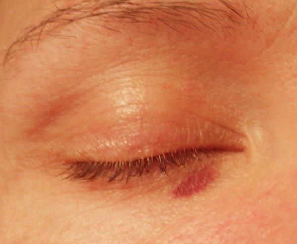 Les masques pour la personne avec lacide salicylique les rappels