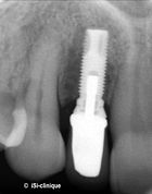 140px-Rx-implant-unit-iSi.jpg
