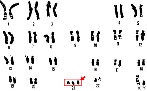 caryotype-Tri21.png
