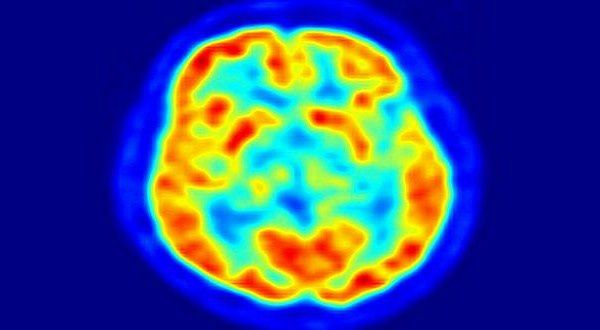 Cerveau-imagerie-cerebrale-TEP-600x330.jpg