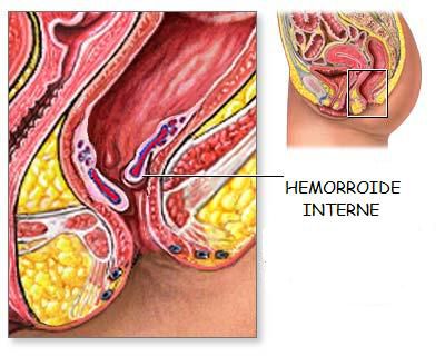 hemorroide