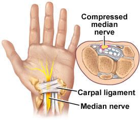 Carpal tunnel steroid injection complications