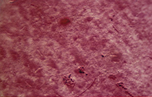 DIAGNOSTICO DE MYCOBACTERIUM TUBERCULOSIS diagnostico de mycobacterium tuberculosis: