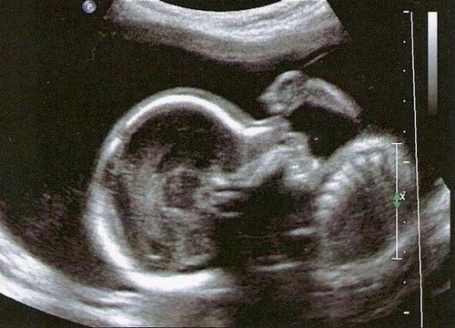 2eme echographie 2eme echographie