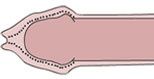 phimosis-croquis.jpg