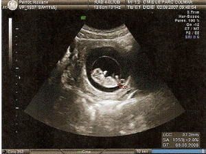 1ere echographie grossesse 1ere echographie grossesse