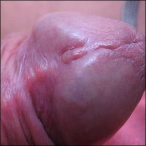 Le blog de Bitouille - Blog d'information sur l'ablation du frein du pénis  dans un cadre médical. Les photos exposées permettent de suivre l'évolution  des suites de l'opération.
