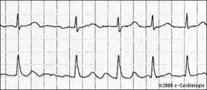 electrocardiogramme.jpg