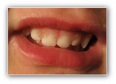 orthodontie signes précoces des malocclusions