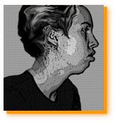 allergie et respiration par la bouche