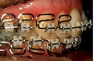 orthodontie bagues induisent prolifération bactérienne