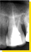 dent devitalisee attention aux extractions systematiques