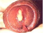 Syphilis - American Osteopathic College of Dermatology (AOCD)