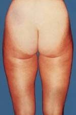 lipo_E5b.jpg