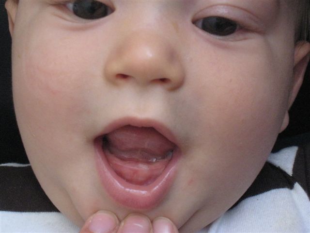 tache blanche gencive bébé tache blanche gencive bébé