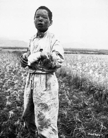 Boy victim of napalm