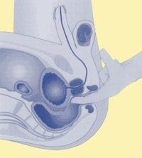 Trois hernies dans le service cervical que faire