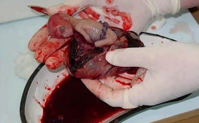 filepicker_RV12S4kTiintVCsqyXsQ_avortement-embryon.jpg