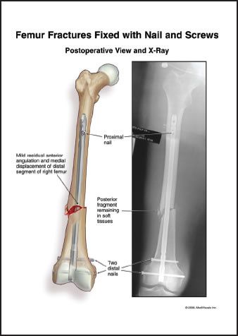 femur-fracture.jpg