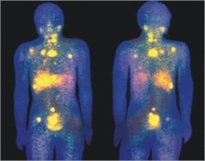traitement immunothérapie most cancers