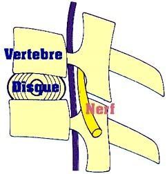 hernie3