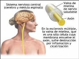 Escleorosis-multiple.jpg