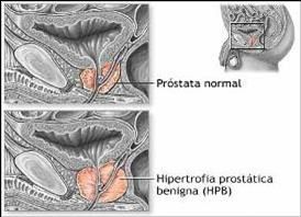inflamacion-de-la-prostata.jpg