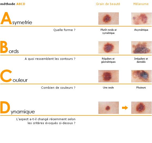 Cancer vessie metastatique sehr kleine melanome