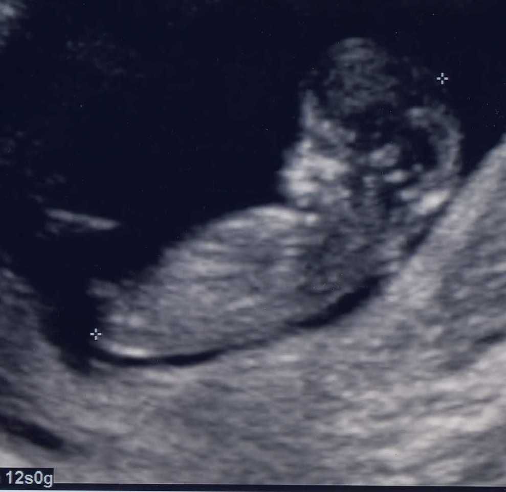 foetus, embryon de 10 semaines