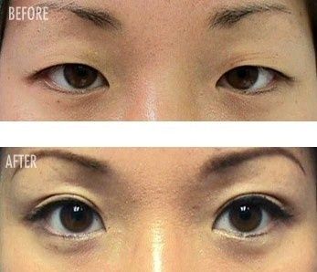 eyelid-tape-before-after.jpg