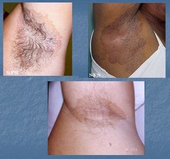 El hongo de las uñas la última fase el tratamiento