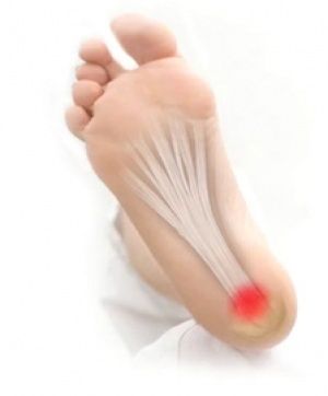 fascitis-plantar-dolor-en-la-planta-del-pie.jpg
