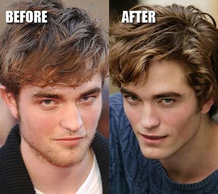 robert-pattinson-before-and-after-plastic-surgery--copie-1