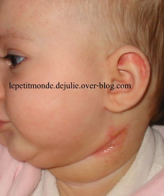 comment soulager eczema bébé