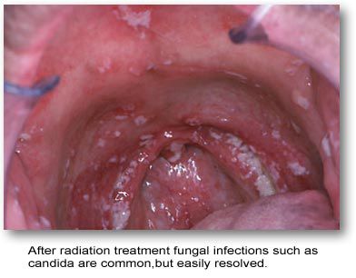 candidiase genital