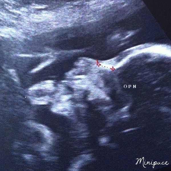 echographie-bebe-2eme-trimestre