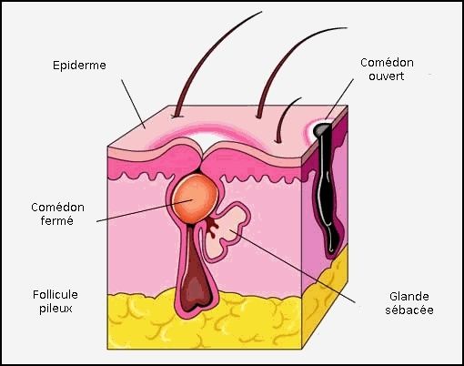 La crème des boutons sur la personne