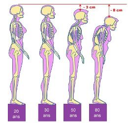Osteoporose-taille.jpg