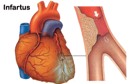 infarctus.png