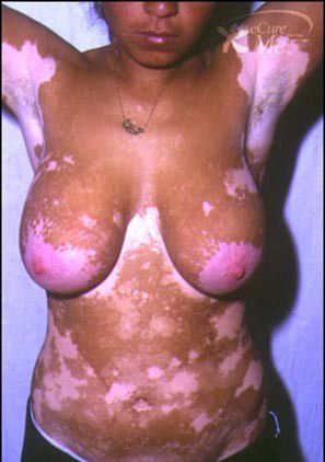 vitiligo4.jpg