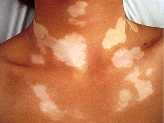 Chinois la cosmétologie aux taches de rousseur