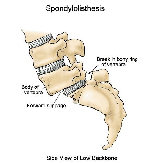 spondylolisthesis