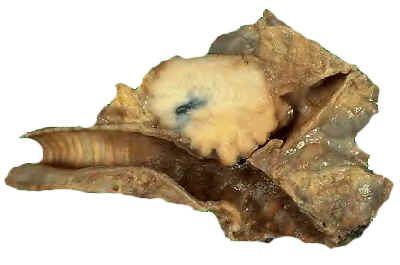lymphome uterus most cancers des ovaires et metastases au foie