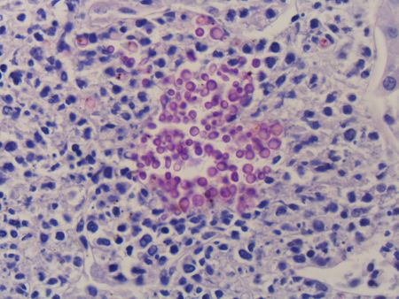 Candidiasis - PAS