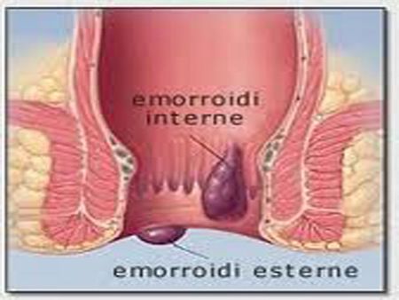 disegno anatomico raffigurante le emorroidi