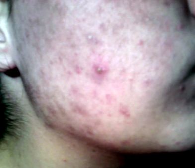 1 A 16 years old teenager with acne on his cheek - photo taken with fl
