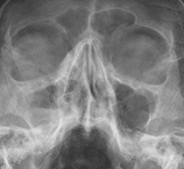 1 Sinusitis maxillaris (Kieferhöhlenentzündung) rechts also links im