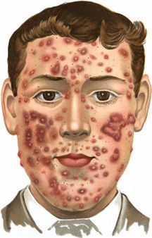Acne (indurta) | Source last Walker | first Norman Purvis | title An i