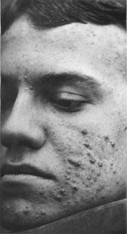 Acne vulgaris | Source last Fox | first George Henry | title Photograp